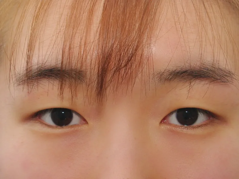 꽁꽁매듭 자연유착 수술 전
