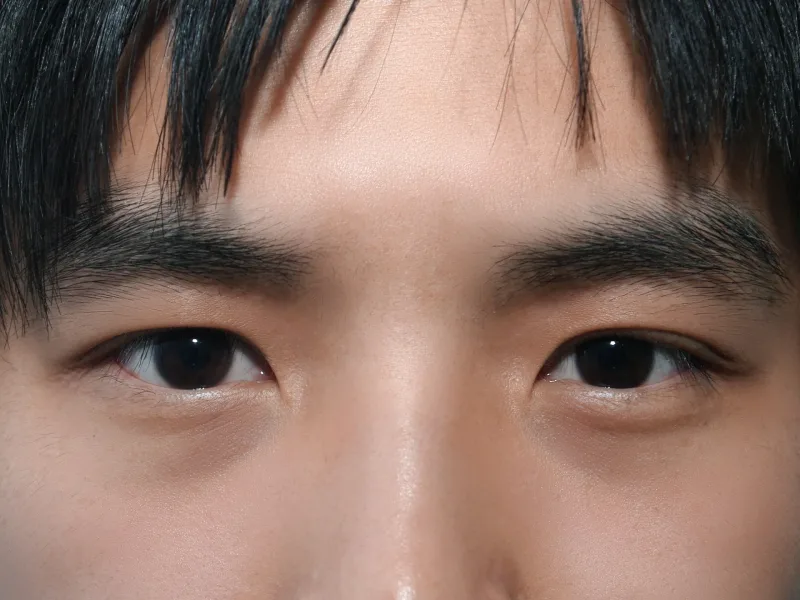 남자 무쌍 눈매교정술 수술 후