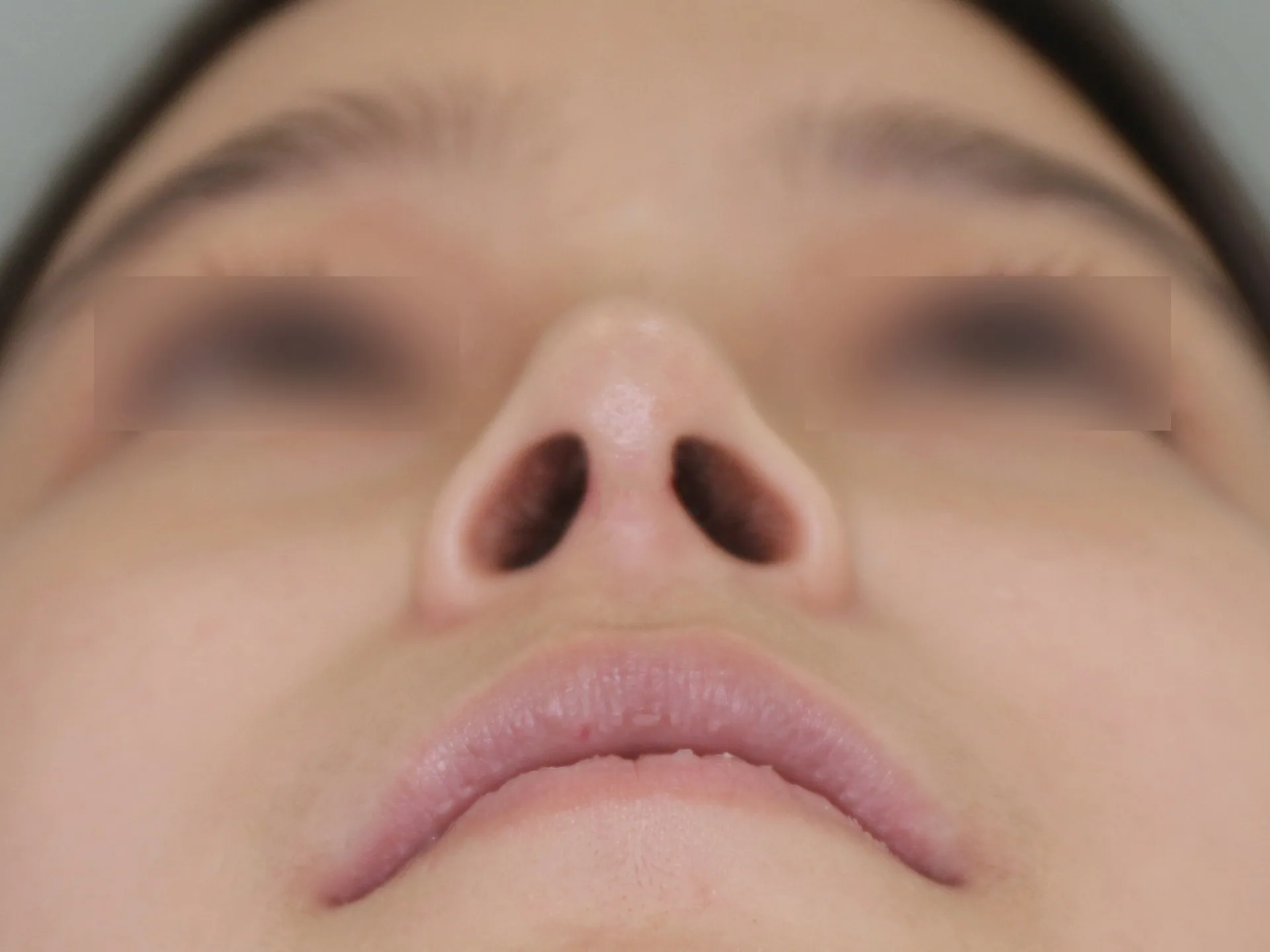수술 후