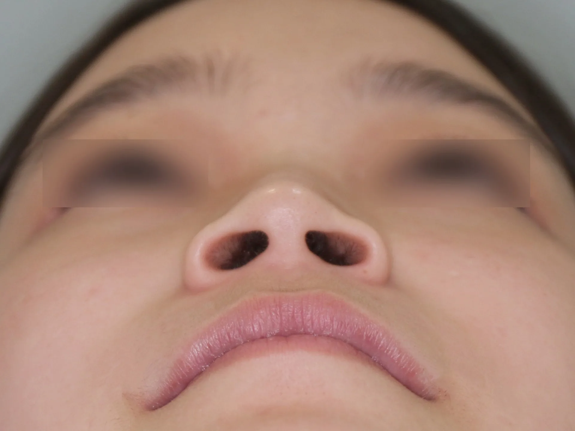 수술 전